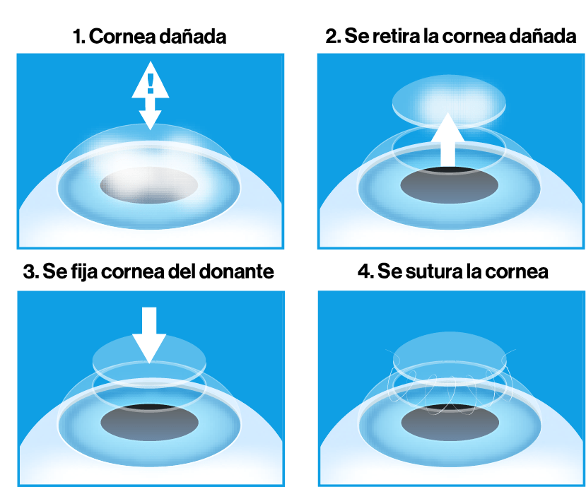 Cómo es una trasplante de córnea