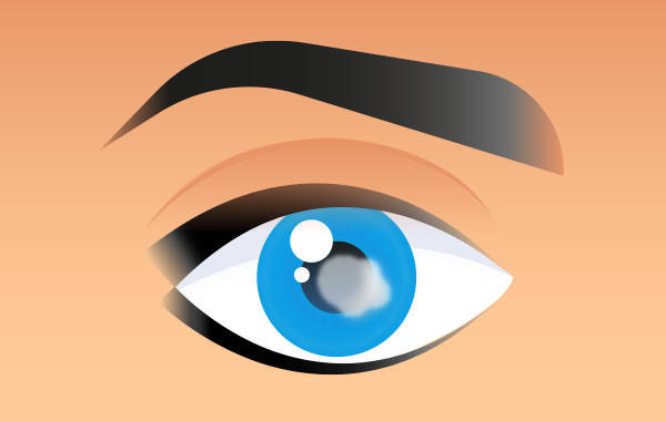 Úlcera corneal en el ojo