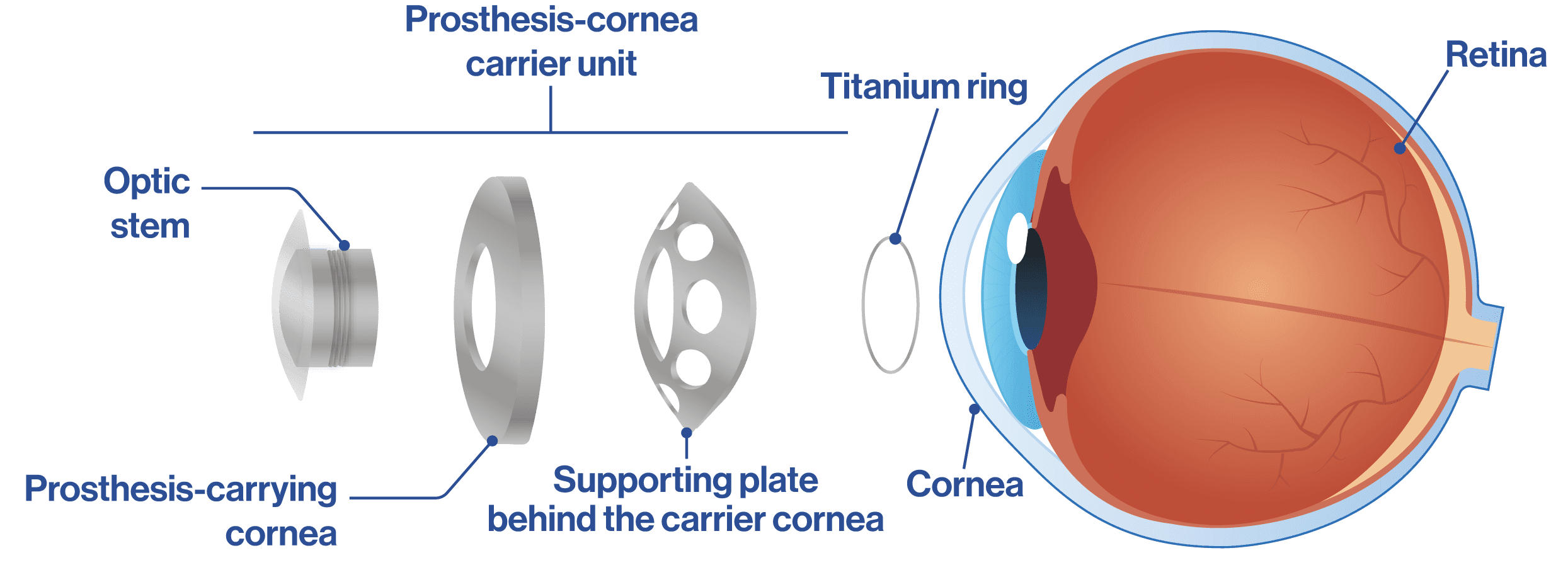 Boston Keratoprosthesis