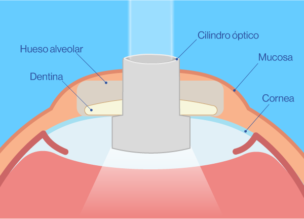 Osteo-Odonto Queratoprótesis