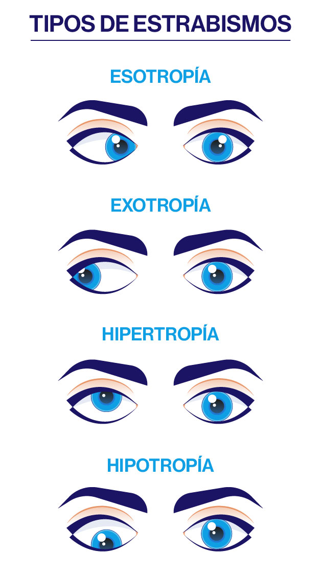 Tipos de estrabismo