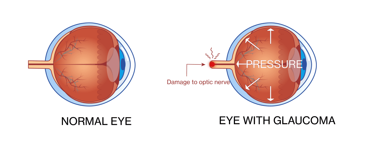 Ocular glaucoma