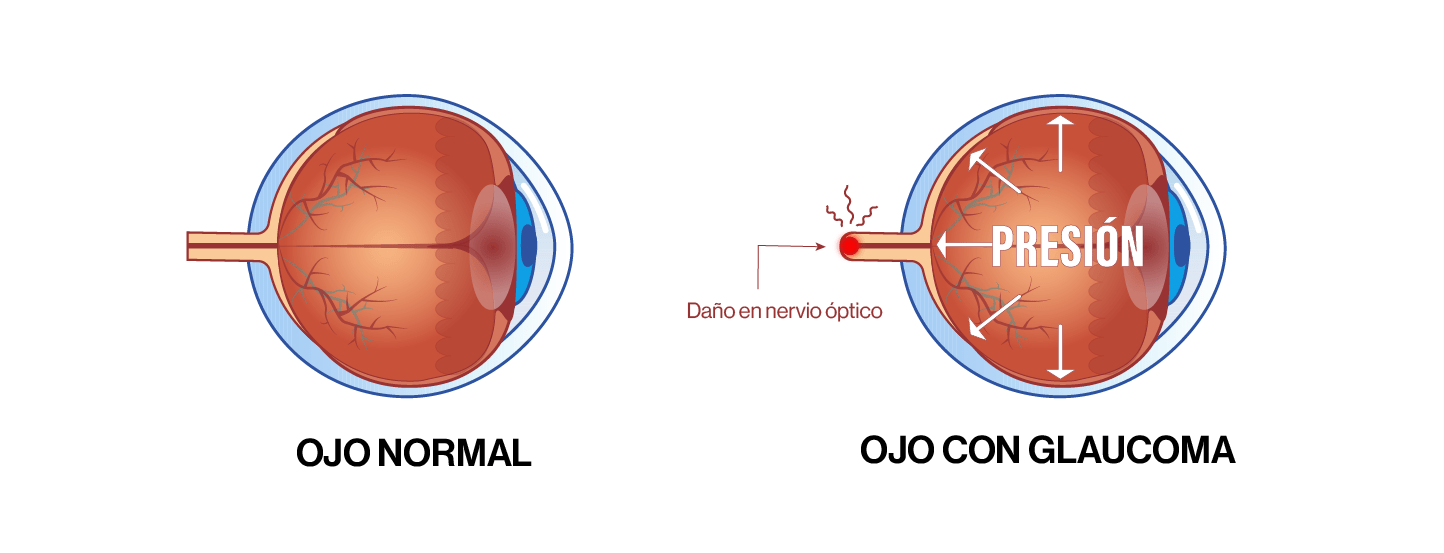 Glaucoma ocular