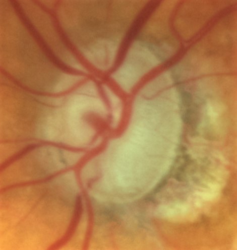 Tratamiento-de-ojo-con-glaucoma