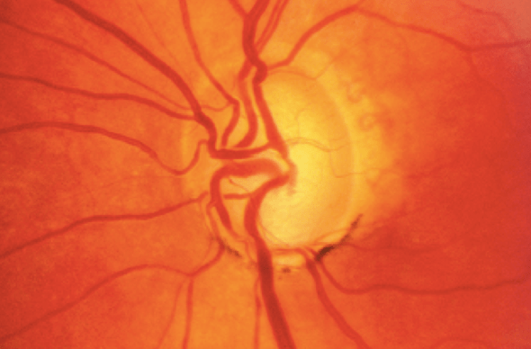 glaucoma fondo de ojo