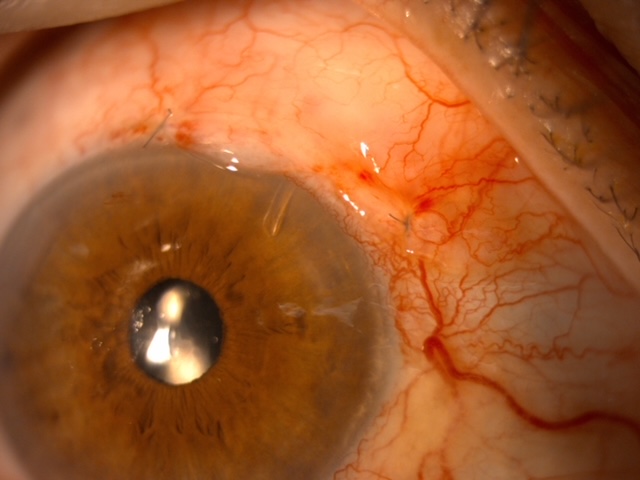 Ojo con glaucoma