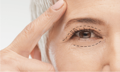 Blepharoplasty or eyelids surgery