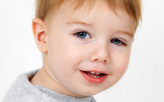 Ptosis palpetral infantil