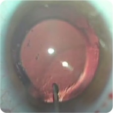 Implante lente intraocular