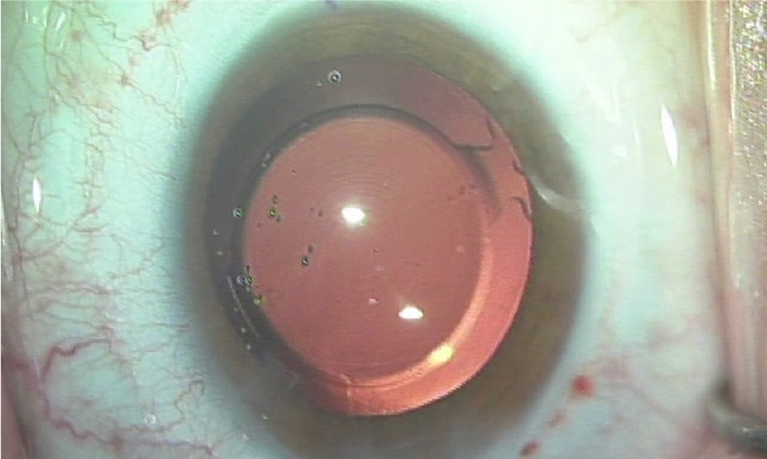 operacion presbicia lentes