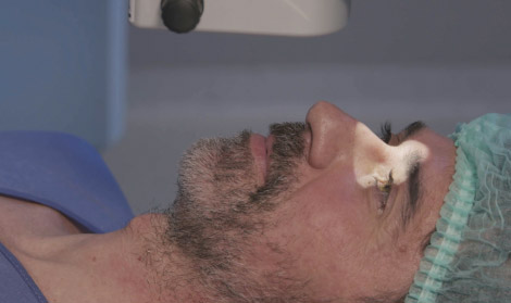 Corrección visual láser