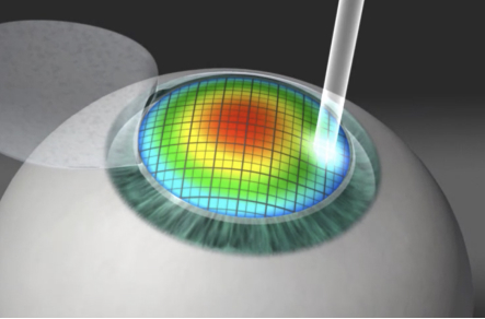 cirugia-refractiva-la-operacion4