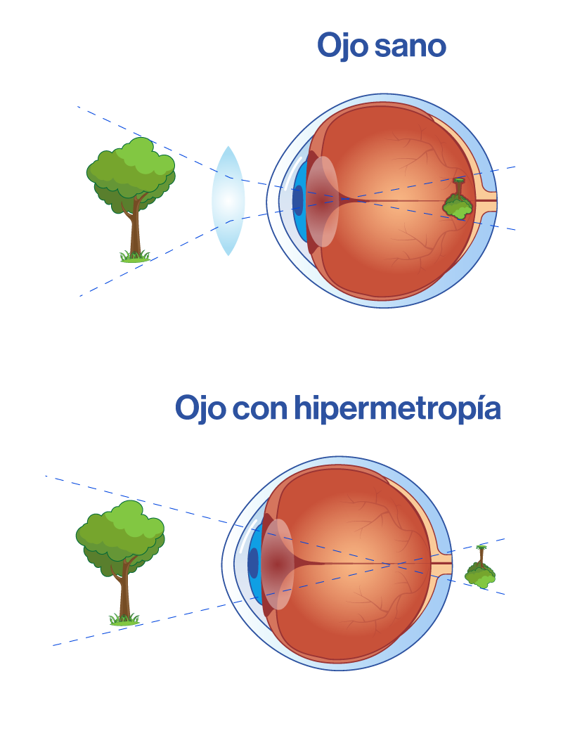 Ojo con hipermetropía