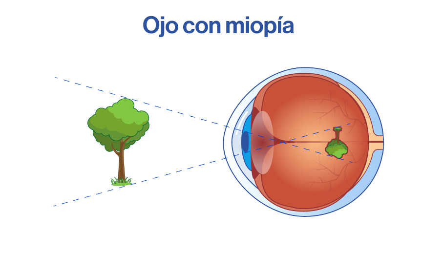 Ojo con miopía