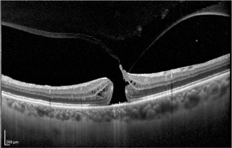 Agujero macular completo fondo de ojo