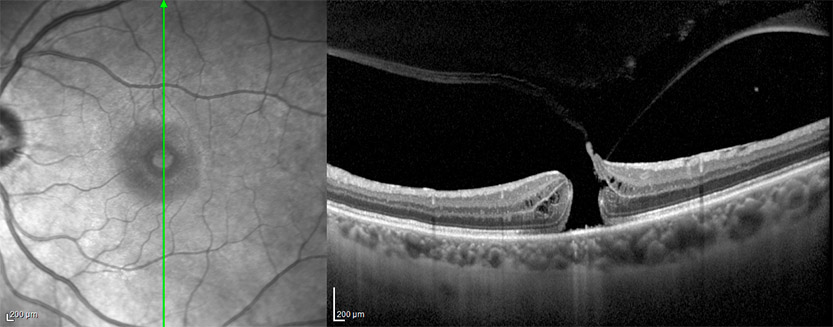 Agujero macular por tomografía de fondo de ojo