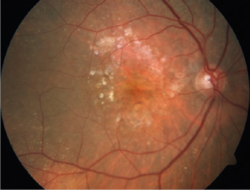 Degeneración macular fondo de ojo