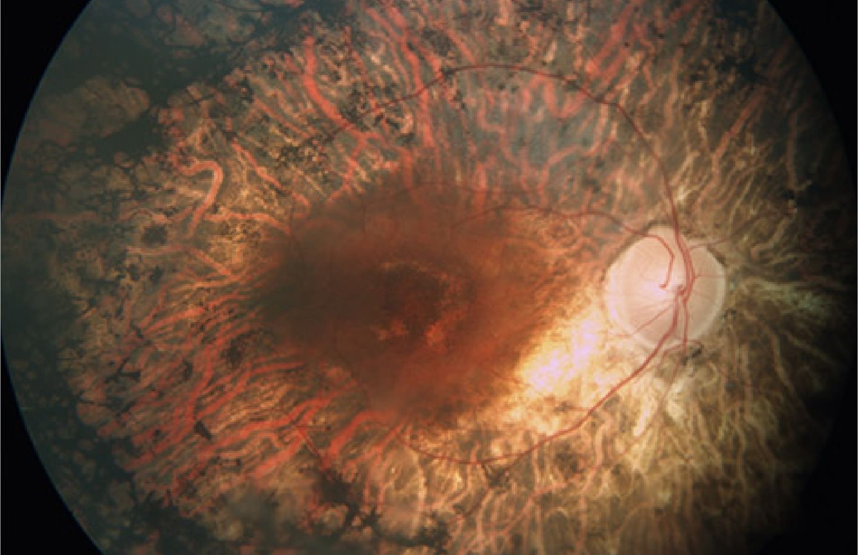 Distrofia en retina integral