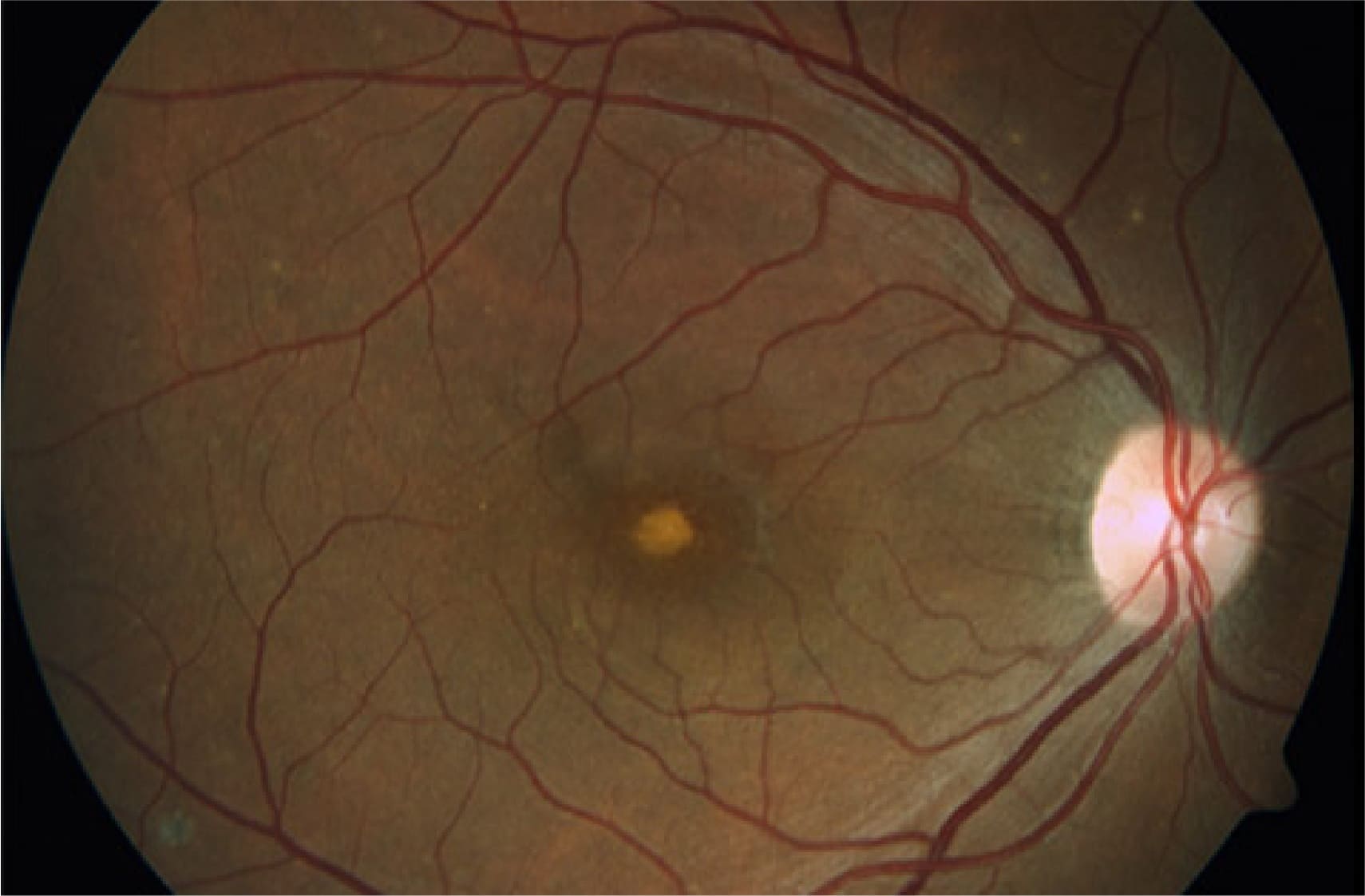 Distrofia en retina y mácula