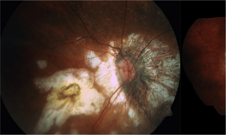 Enfermedad ocular por alta miopía
