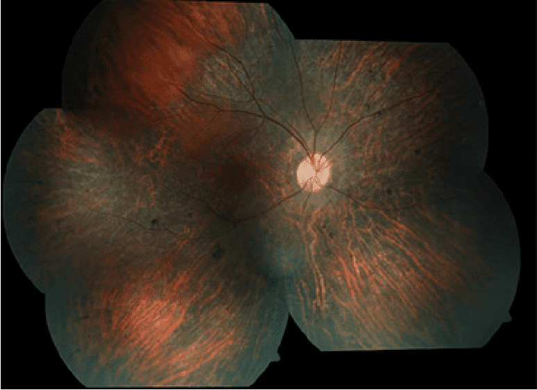 Enfermedad por retinosis pigmentaria