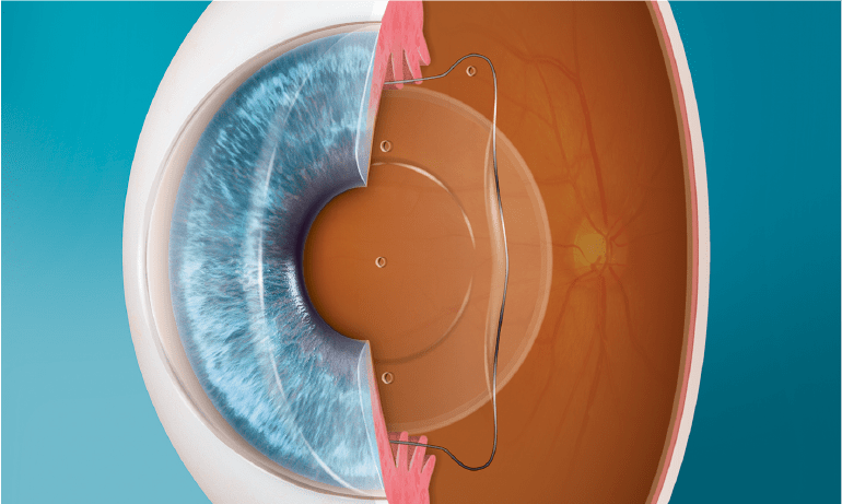 Implante lente ICL en ojo