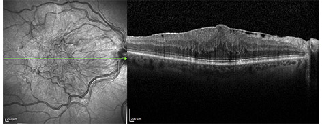 Membrana epirretiniana fondo de ojo