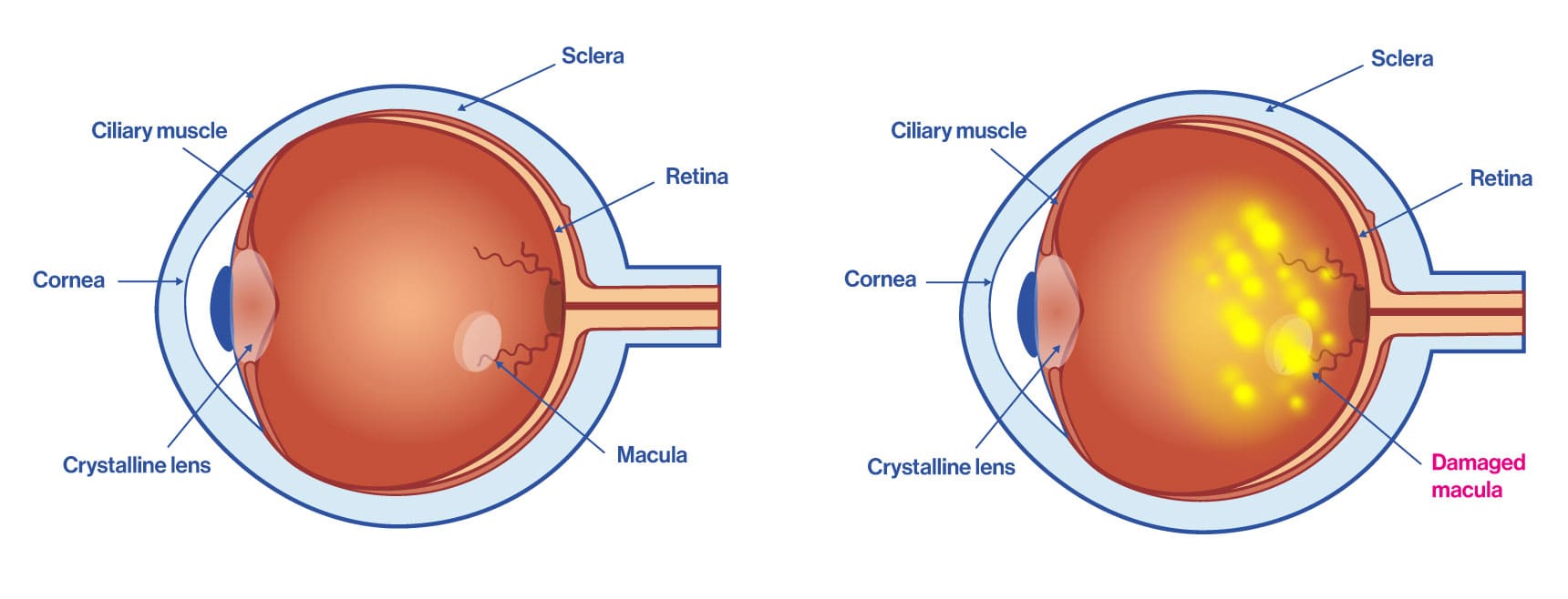 Eye with macular degeneration or AMD