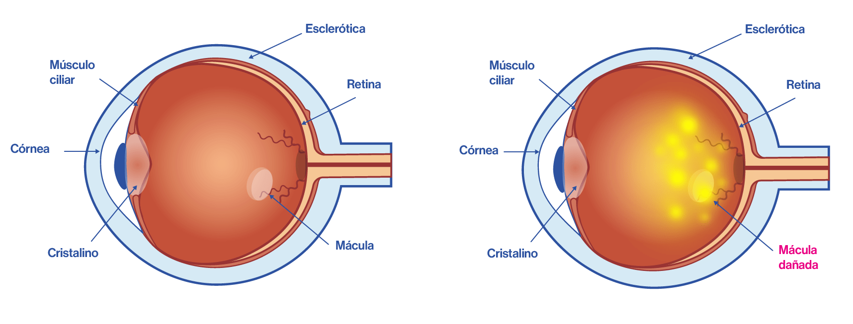 Ojo con degeneración macular o DMAE