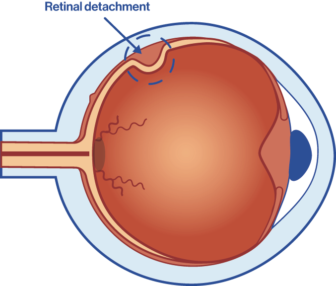 Eye with retinal detachment