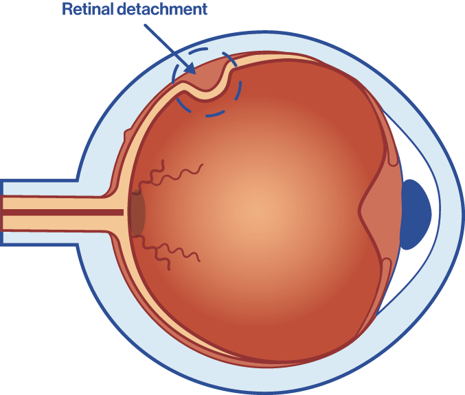 Retinal Detachment Symptoms Causes And Operation Oftalvist