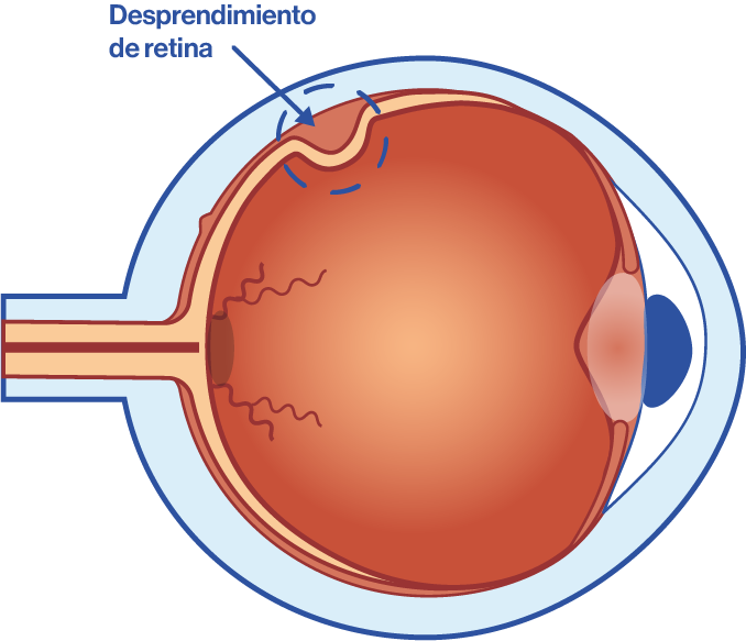 Ojo con desprendimiento de retina