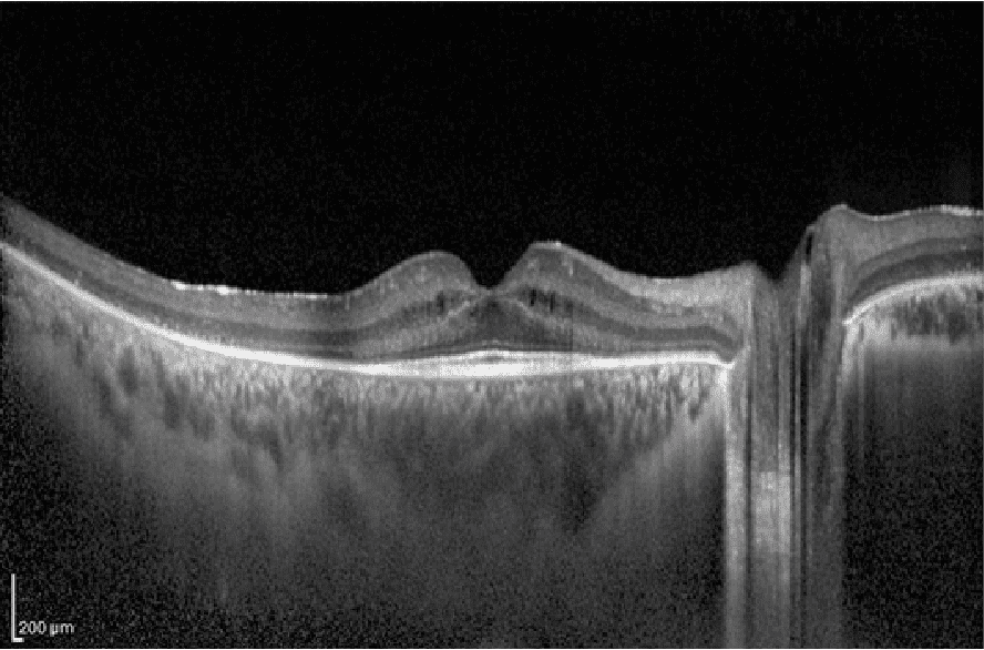 Ojo con retinosis pigmentaria