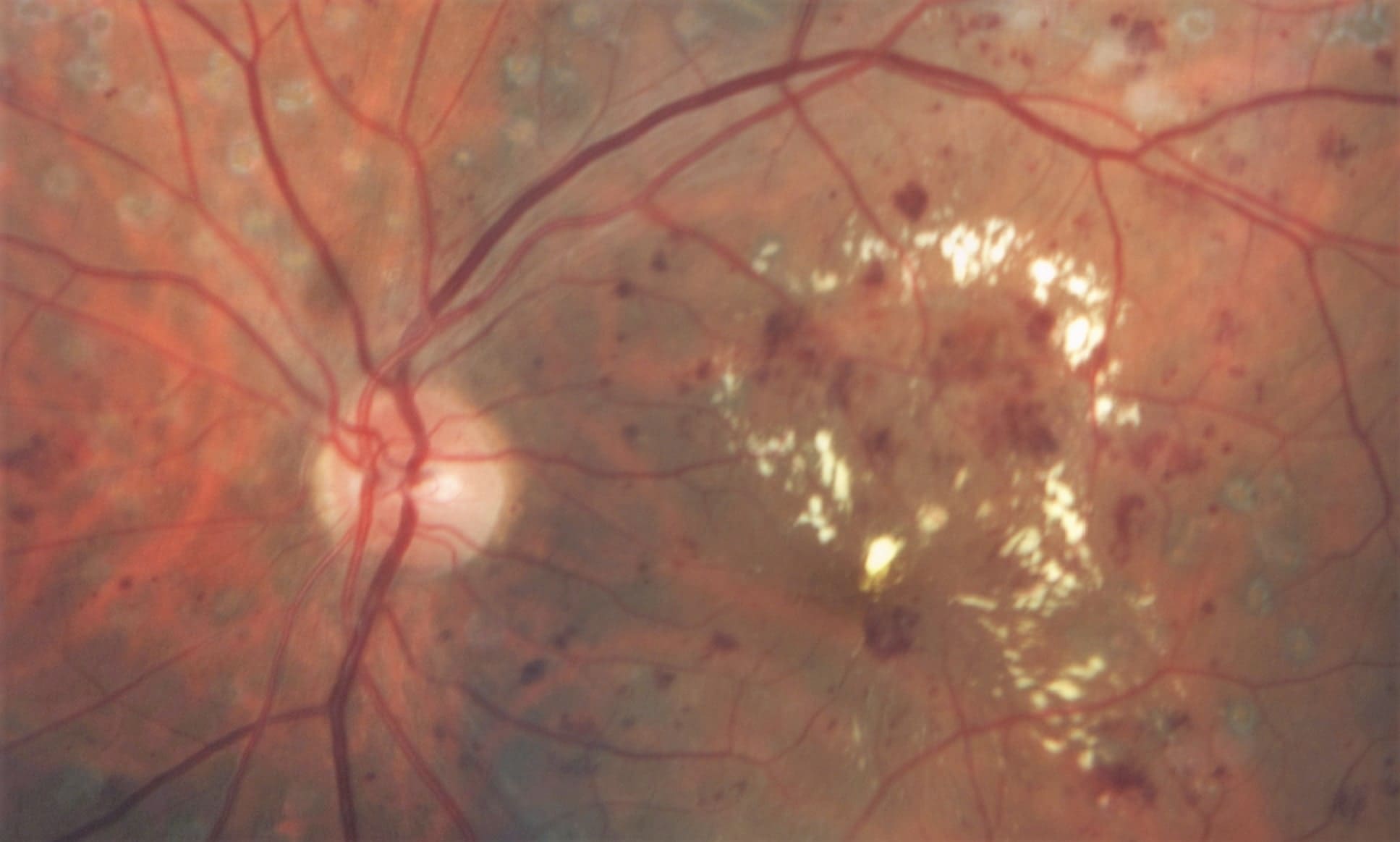 Retinopatía diabética fondo de ojo
