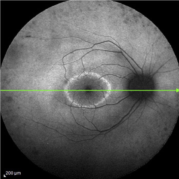 Retinosis pigmentaria - Fondo de ojo