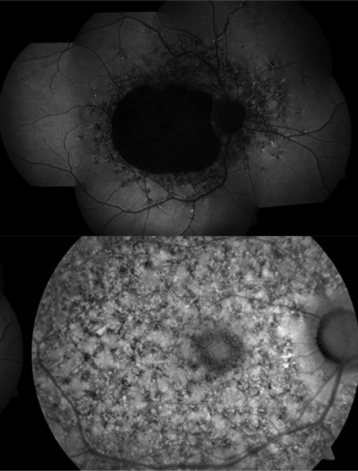Tomografía de coherencia óptica en distrofia en retina