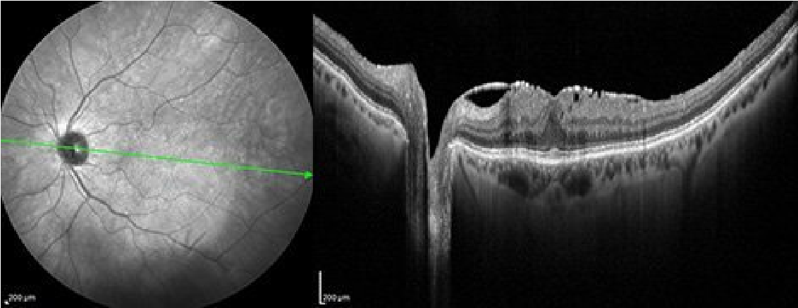 Tomografía de coherencia óptica en membrana epirretiniana