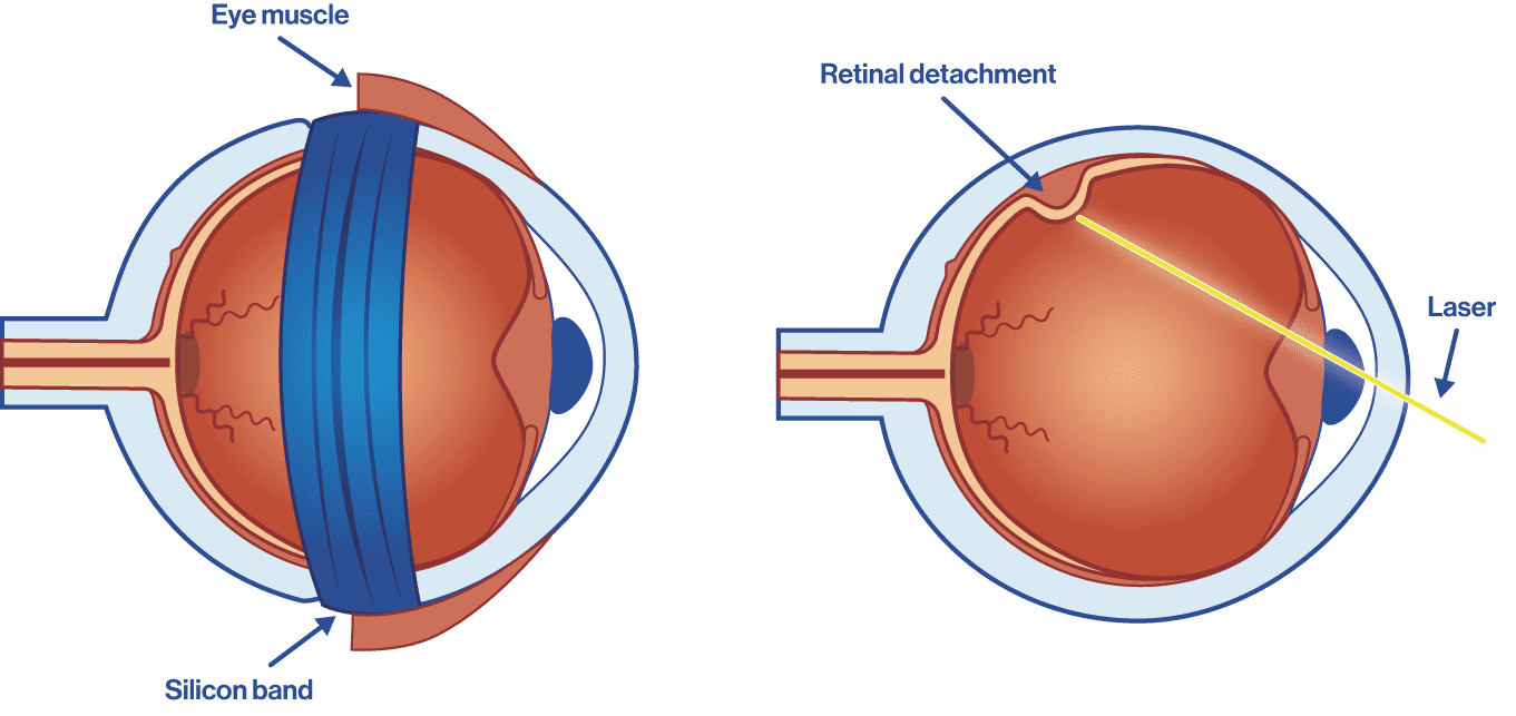 Vitrectomy for retinal detachment