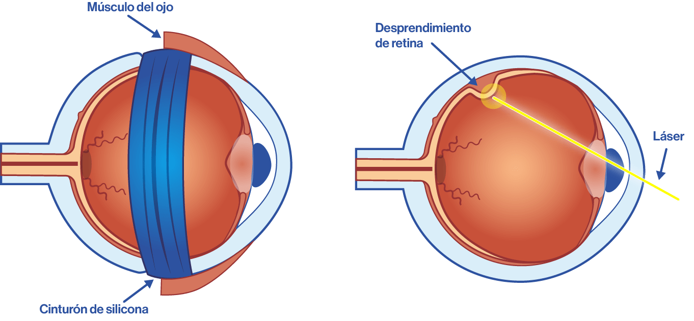 Vitrectomía por desprendimiento de retina