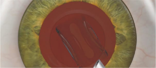 Implante de lente intraocular